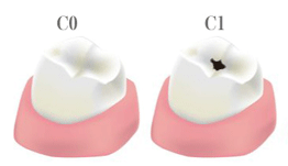 初期むし歯と進行したむし歯
