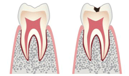 初期むし歯と進行したむし歯その２