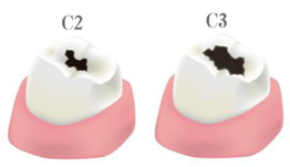 より進行したむし歯とさらに進行したむし歯