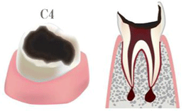 非常に進行したむし歯（主にC4）