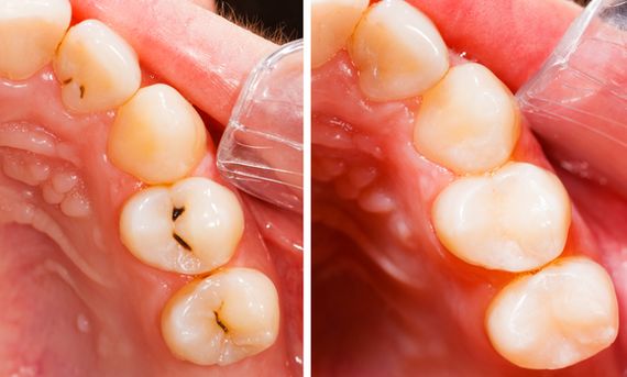 コンポジットレジン修復