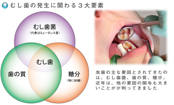むし歯の３大要素