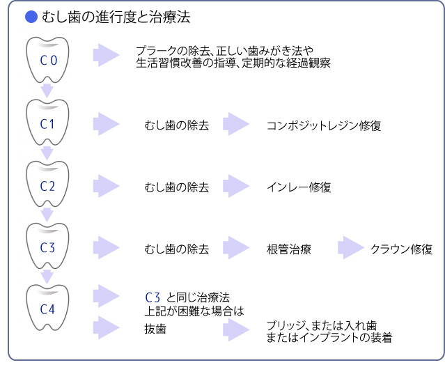 むし歯の進行度と治療法