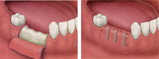 インプラント手術２回法