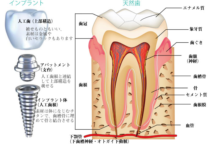 第３の歯インプラント