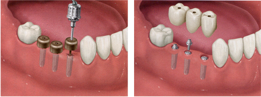 インプラント手術１回法