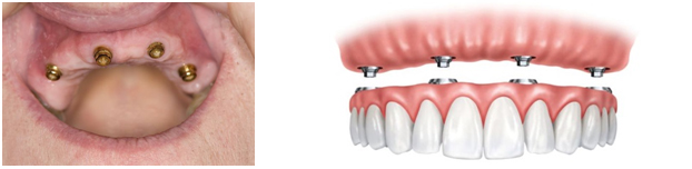 インプラントアールオン４