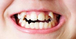 八重歯イメージ