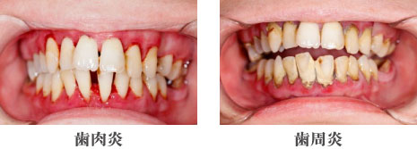 歯肉炎・歯周炎