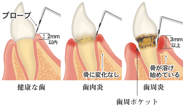 歯肉炎・歯周炎・歯周ポケット