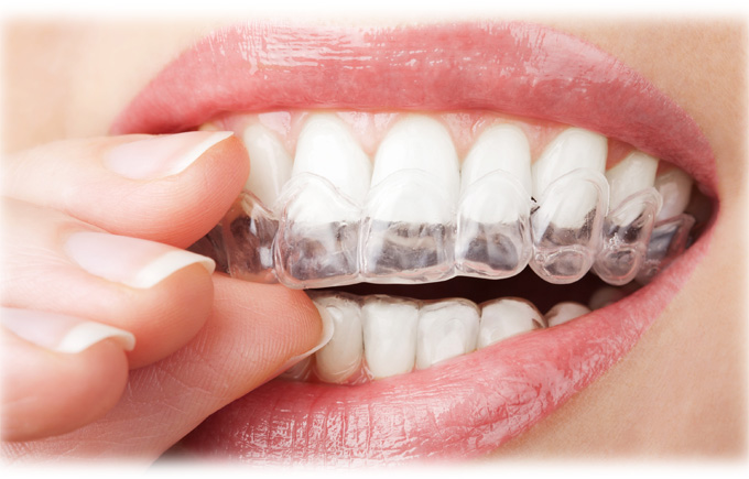 ホーム・ホワイトニング