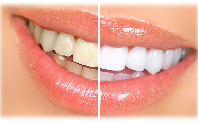 ホワイトニング